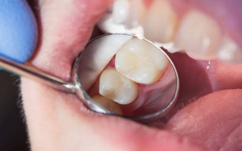 tooth filling Santa Rosa CA